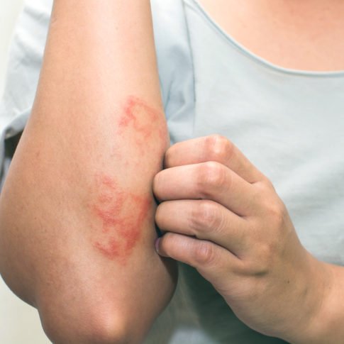 allergia al nichel nutrizione