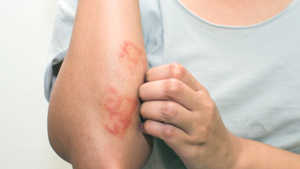 allergia al nichel nutrizione