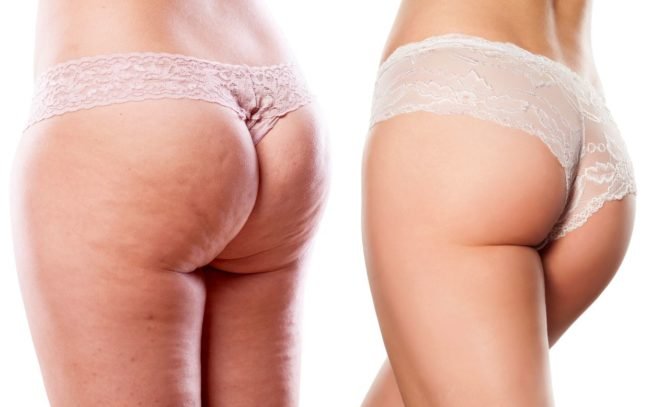 cellulite-o-ritensione-idrica-maxw-1280