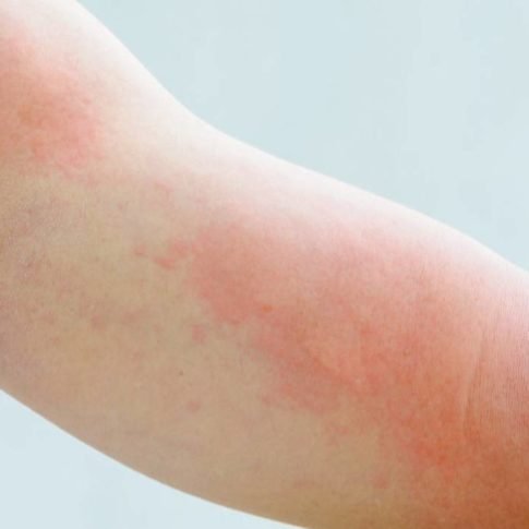 istaminosi e orticaria da nutrizione